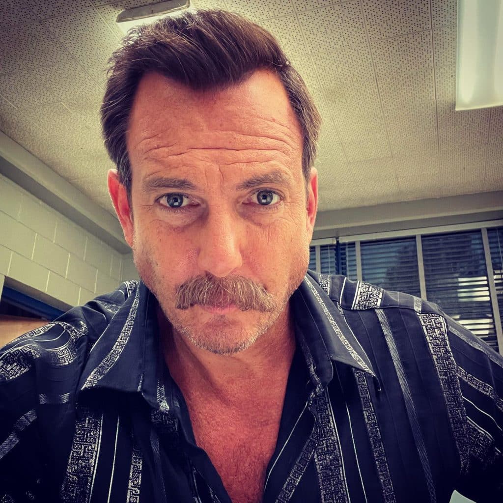 will arnett hair transplant 1